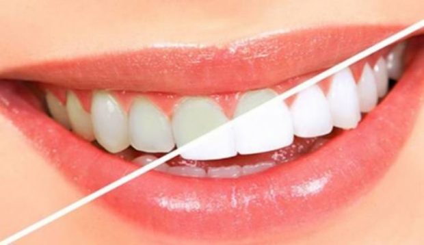Dëshironi të keni dhëmbë të bardhë dhe të shndritshëm? Ja kush janë 9 mënyrat natyrale për të pasur dhëmbë të tilla…