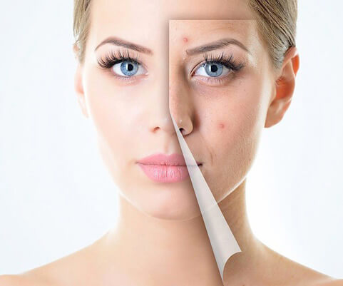 Ju tregojmë gjithçka për aknet në fytyrë gjatë periodave: Si, përse dhe çfarë duhet të dimë?