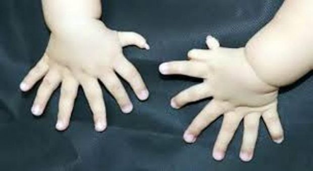 A janë shumë 7 gishta në dorë? Wow! 31 gishta tek gjymtyrët e një foshnje (FOTO)