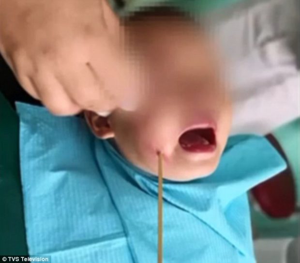 E PABESUESHME/ Fotot: Dy vjeçares i ngec shkopi në gojë
