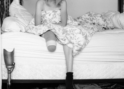Historia e trishtë e modeles së njohur/ Humbi këmbën nga një tampon (FOTO)