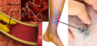 Katër shenjat që paralajmërojnë për mpiksje të gjakut, njihuni me faktorët e riskut