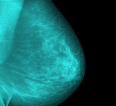 KINI KUJDES! Ja 6 simptoma të kancerit të gjirit që nuk kanë lidhje me gjëndrën