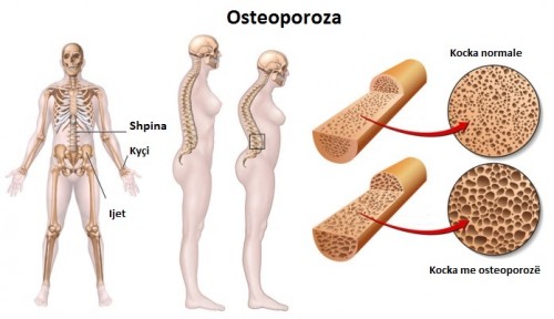 “OSTEOPOROZA”/ Ja si mund të parandalohet dhe trajtohet kjo sëmundje e kockave