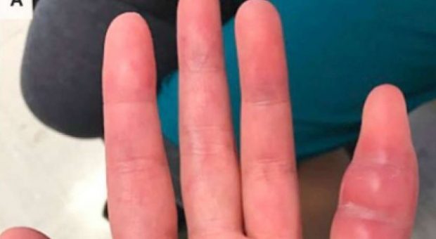 HABITEN MJEKËT/ Zbulojnë infeksionin e rrallë në gishtin e gruas (FOTO)