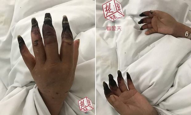 TRONDITËSE/ Nxirja e duarve të 53-vjeçares lidhet me sëmundjen e rëndë