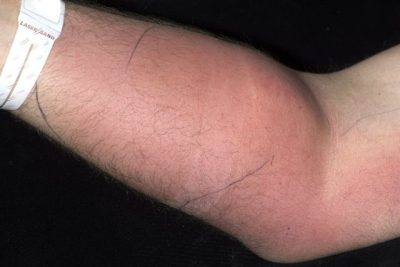 E PAZAKONTË/ Prej 18 muajsh, një burrë injektonte spermë në krah