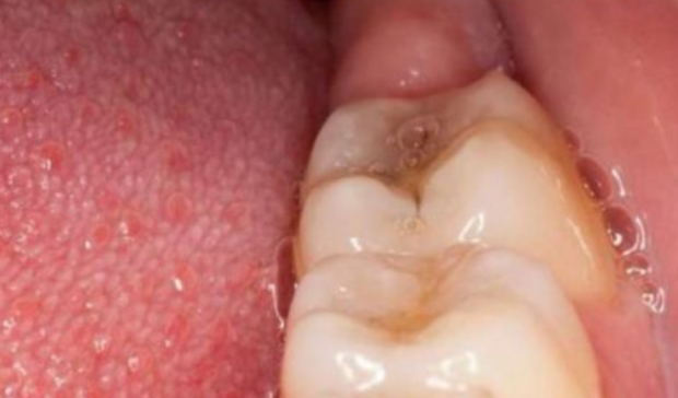 MOS E NEGLIZHONI/ Nëse të dhemb ky dhëmb, ke probleme me këtë organ