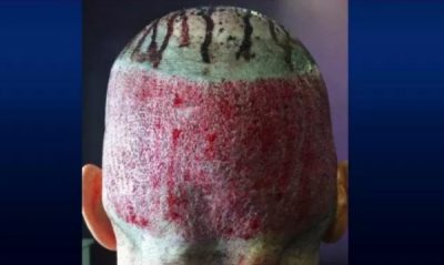 DO SHOKOHENI/ Mjekët publikojnë foto të dështimit të operacioneve për mbjelljen e flokëve