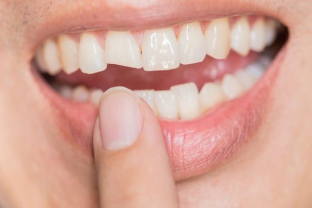 NËSE NUK PASTRONI GURËZAT/ Do të habiteni se çfarë mund t’i ndodhi dhëmbëve tuaj