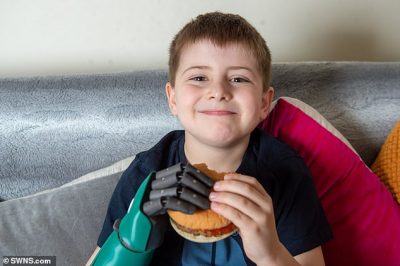 TANI MUND TË HAJË HAMBURGER…/ 8-vjeçarit i ndryshon jeta pasi i vendosin protezën që…