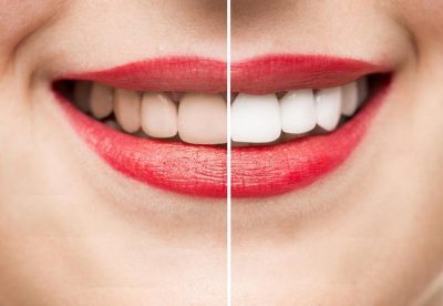 FUNKSIONON MENJËHERË/ Ja receta e vetme natyrale për dhëmbë të bardhë