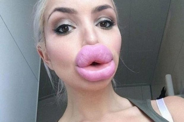 FOTOT VIRALE/ Ky është trendi i rrezikshëm i buzëve që po qarkullon mes vajzave së fundmi