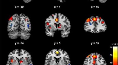STUDIMI/ Mjekësia tregon përfundimisht efektet afatgjate që shkakton marihuana në tru