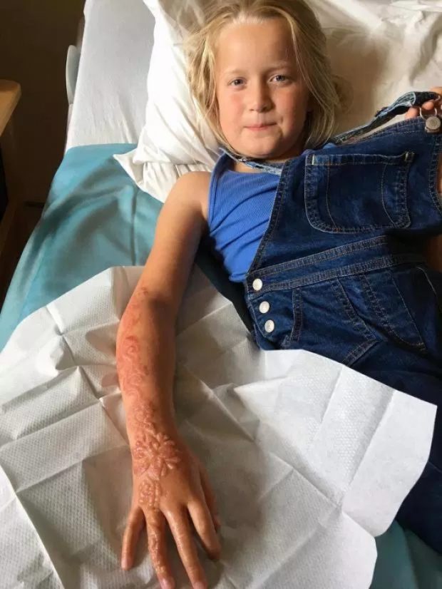 E DHIMBSHME/ Vogëlushja humb lëkurën nga tatuazhi i përkohshëm (FOTO)