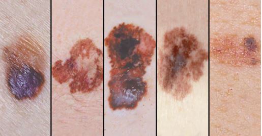 MASAT/ Sa ndikon dielli në shfaqjen e melanomës?