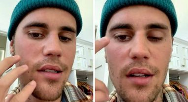 PUBLIKON VIDEON/ Anuloi koncertet sepse gjysma e fytyrës iu paralizua! Justin Bieber në “luftë” me virusin